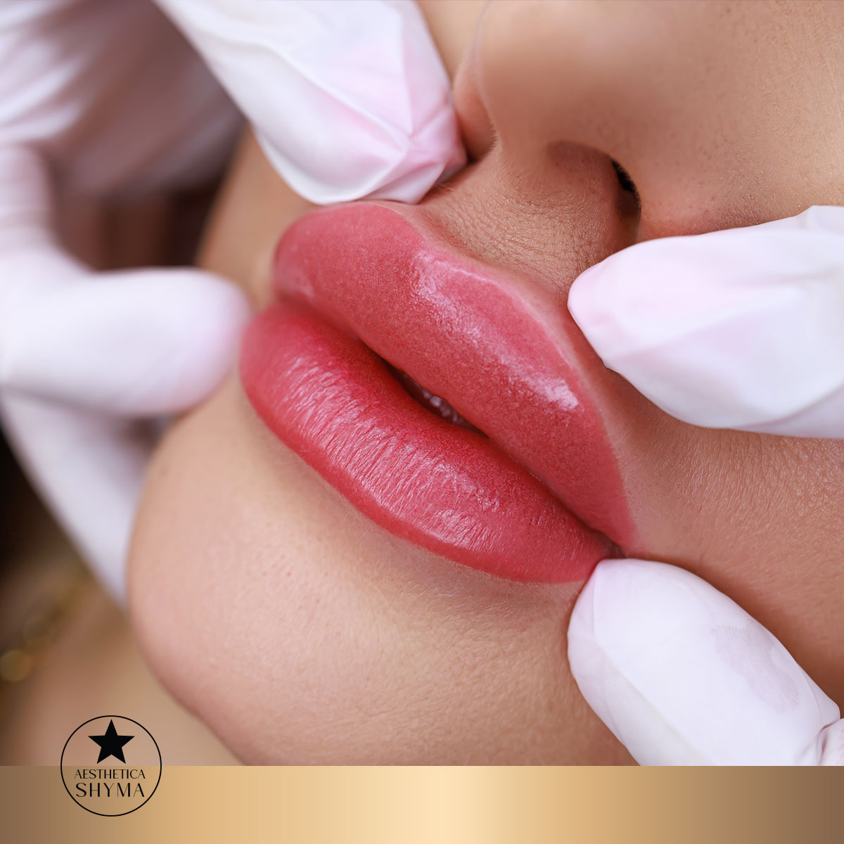 Lip Fillers in Dubai: Get the Perfect, Natural-Looking Lips